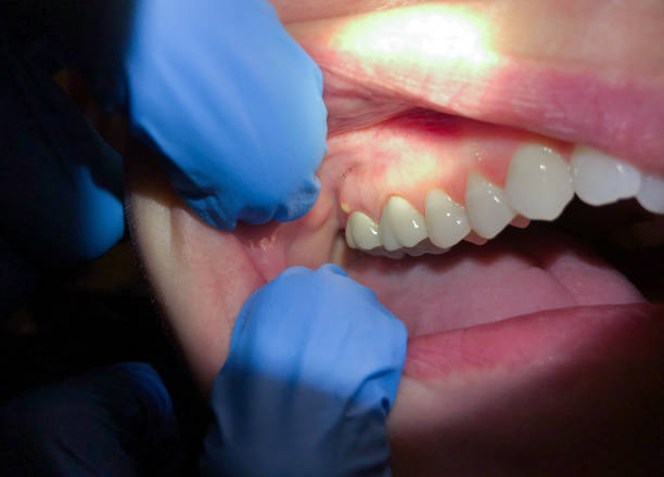 Best Emergency Denture Repair in Greenfield, IL